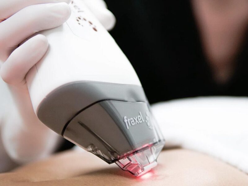Fraxel Laser